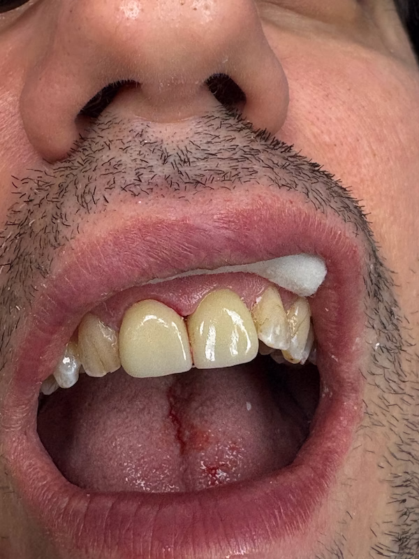 Cosmetic Porcelain Crowns After