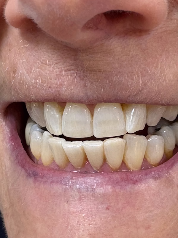Professional Teeth Whitening After