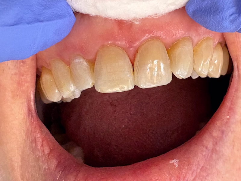 Chipped Front Teeth After