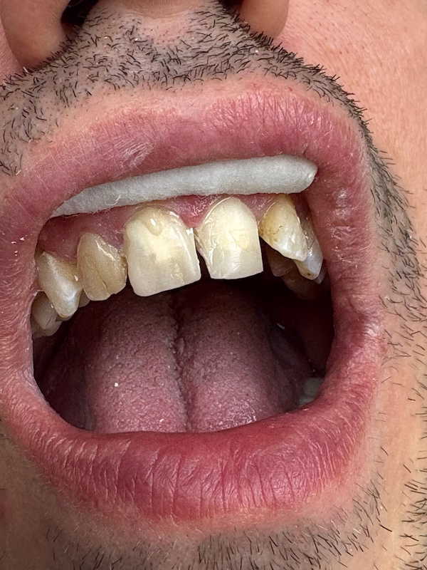 Cosmetic Porcelain Crowns Before