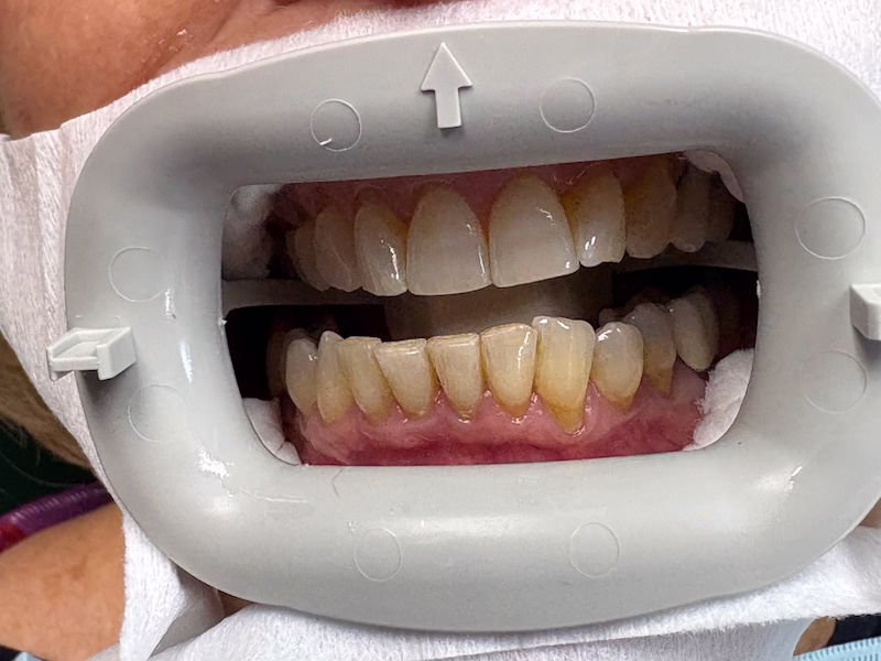 Professional Teeth Whitening Before