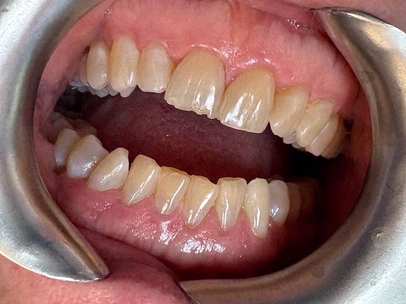 Chipped Front Teeth Before