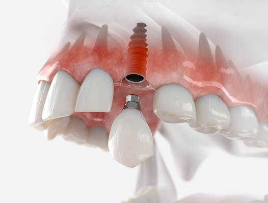 Dental Implant Ridgewood, NJ