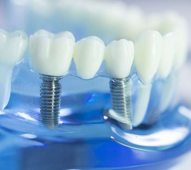 Ridgewood Dental Implants